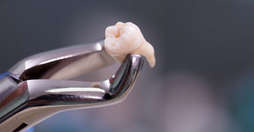 Удаление зуба