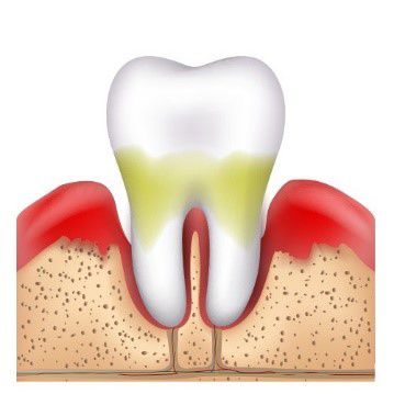 Периодонтит