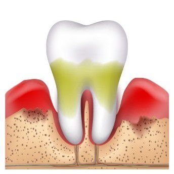 Пародонтоз